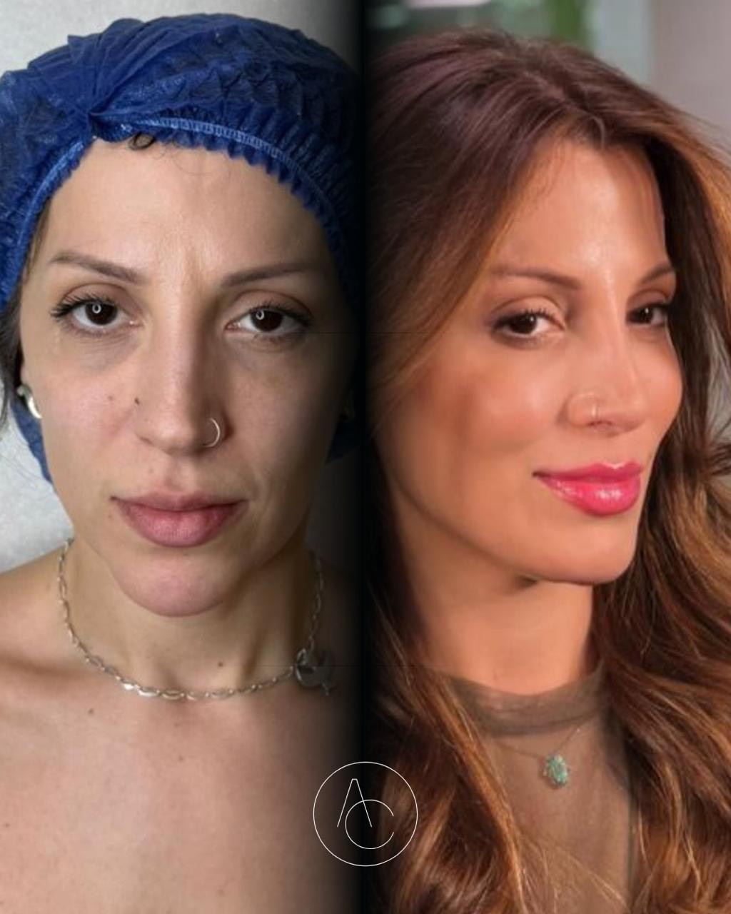 Antes e depois